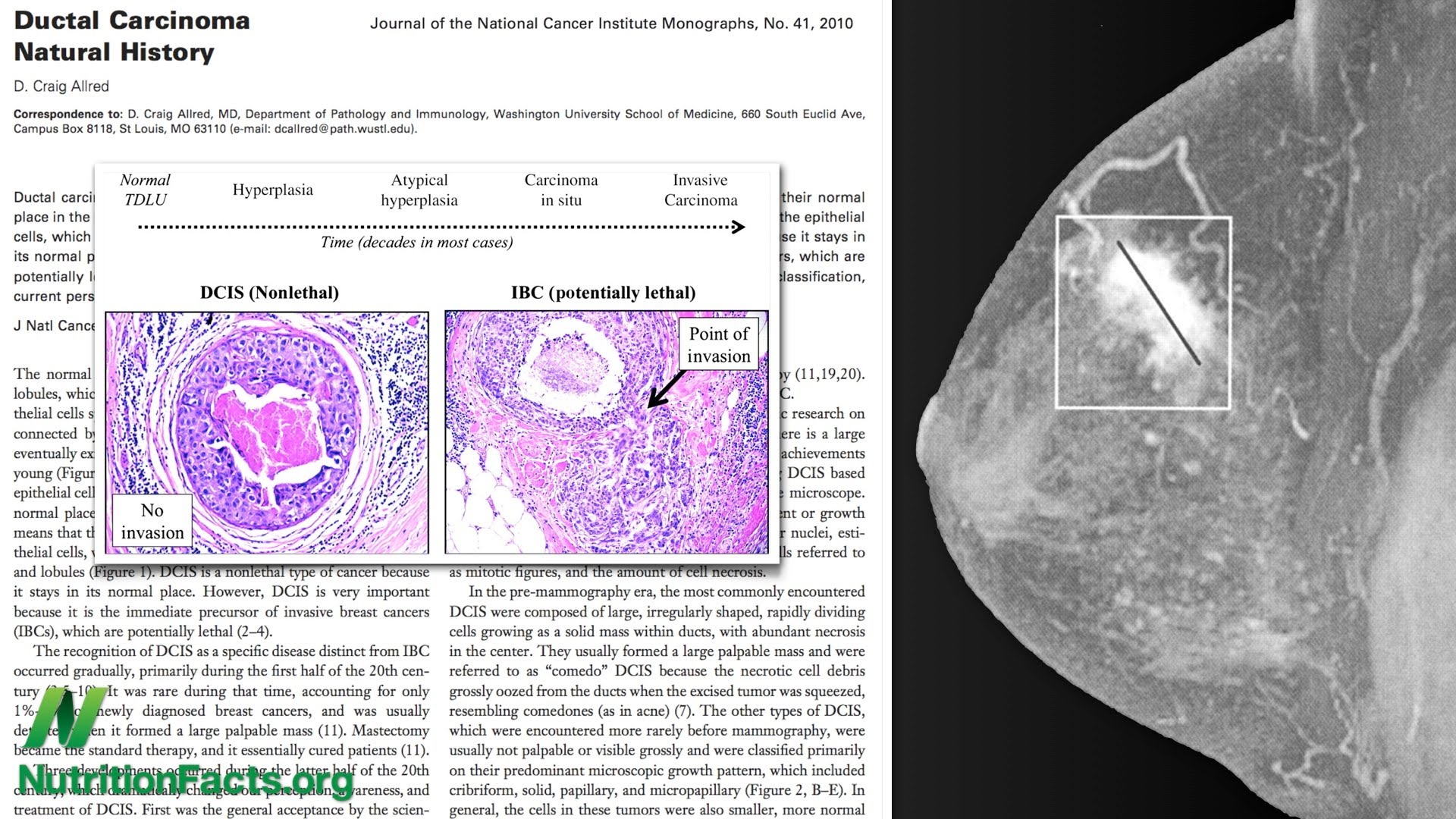 Breast Cancer Survival and Lignan Intake