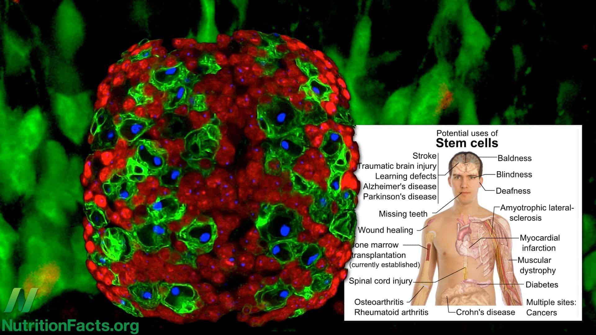 Broccoli Versus Breast Cancer Stem Cells
