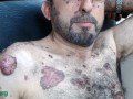 Treating Gorlin Syndrome With Green Tea