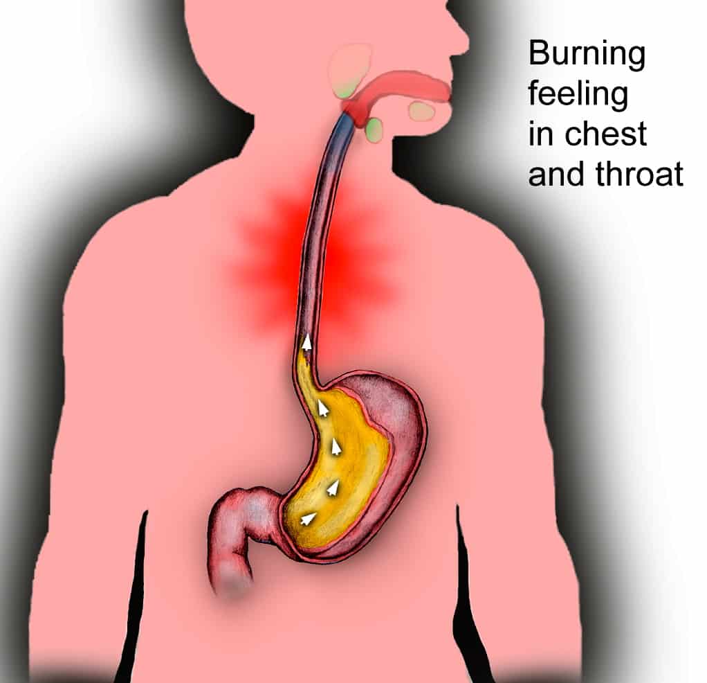 burn m Nutrition reflux recommendations for (GERD acid