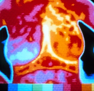 Thermography for Breast Cancer Detection
