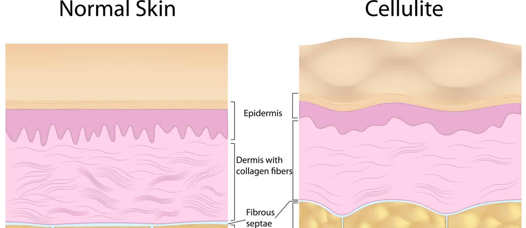 Can Cellulite Be Treated With Diet?