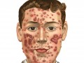 Saving Lives By Treating Acne With Diet