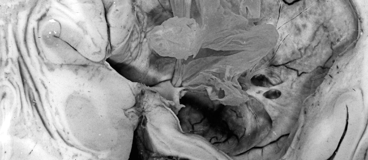 Chronic Headaches & Pork Parasites