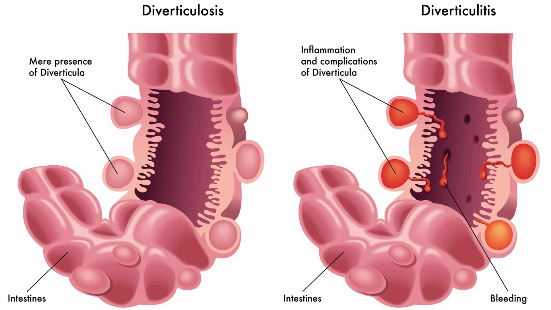 Diverticulosis When Our Most Common Gut Disorder Hardly Existed