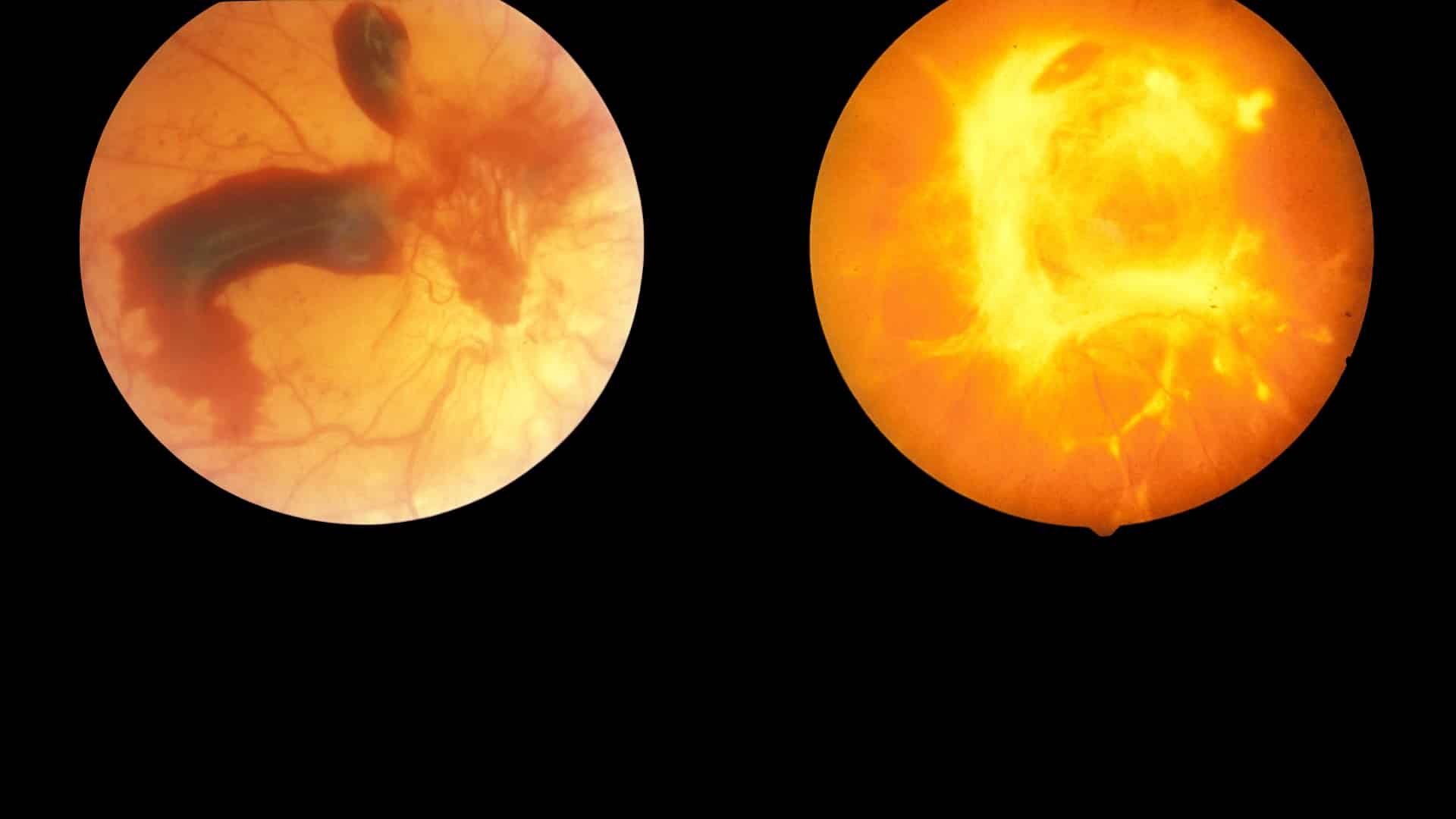 can-diabetic-retinopathy-be-reversed