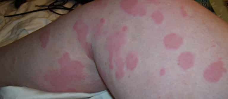 Hives From Tick Bite Induced Meat Allergies