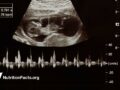 ultrasound of fetus