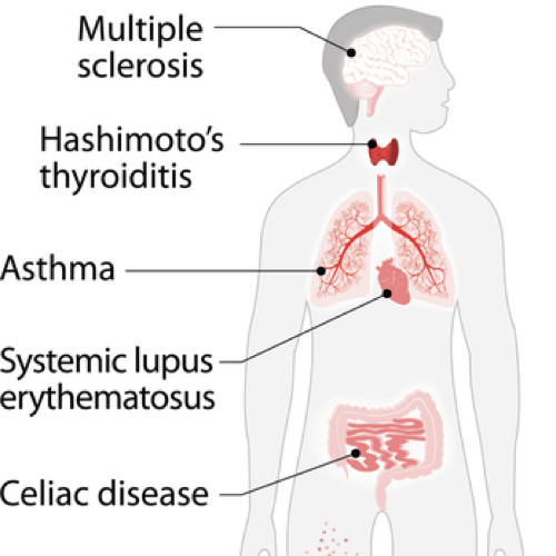 Autoimmune Diseases