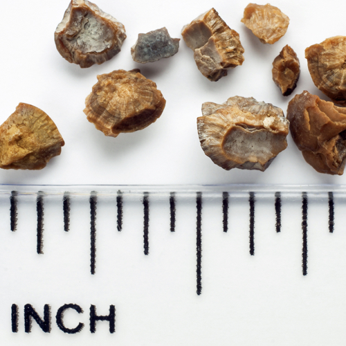 Kidney Stones