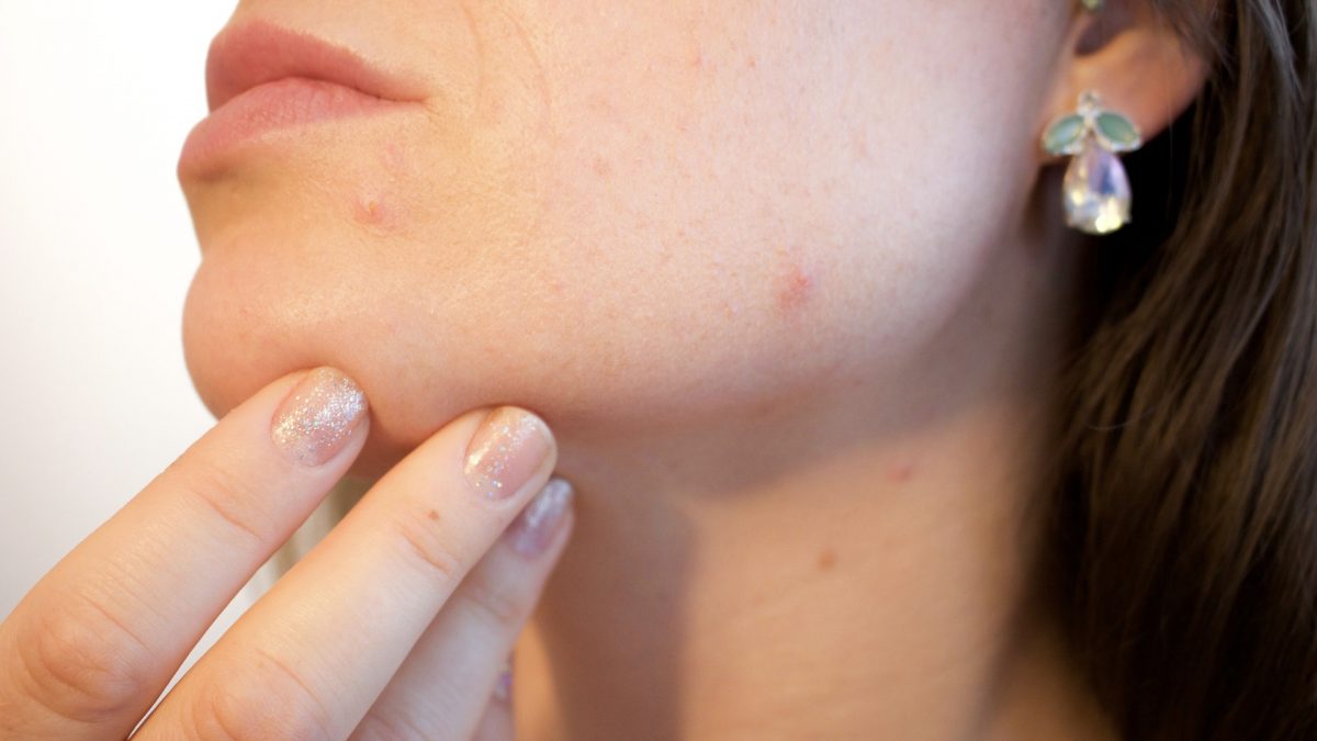 Natural Treatment for Acne and Fungal Infections