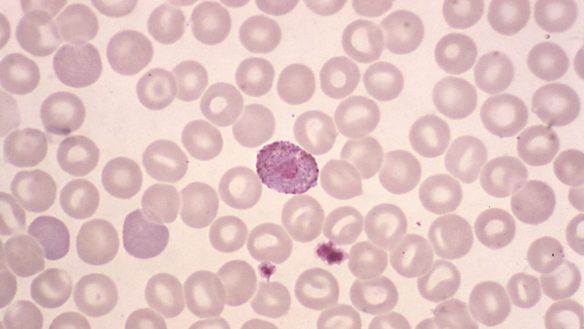 What Does a Low White Blood Cell Count Mean?
