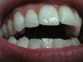 Oil Pulling for Teeth Whitening and Bad Breath Tested