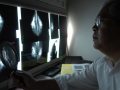 Do Mammograms Save Lives?
