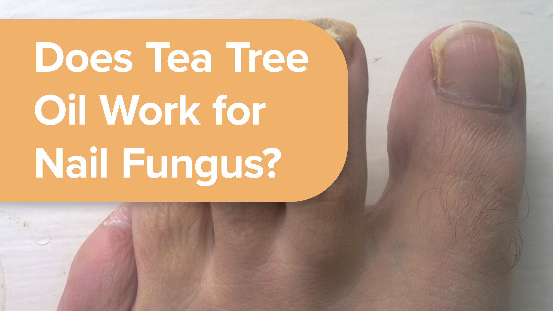 Does Tea Tree Oil Work for Nail Fungus? 