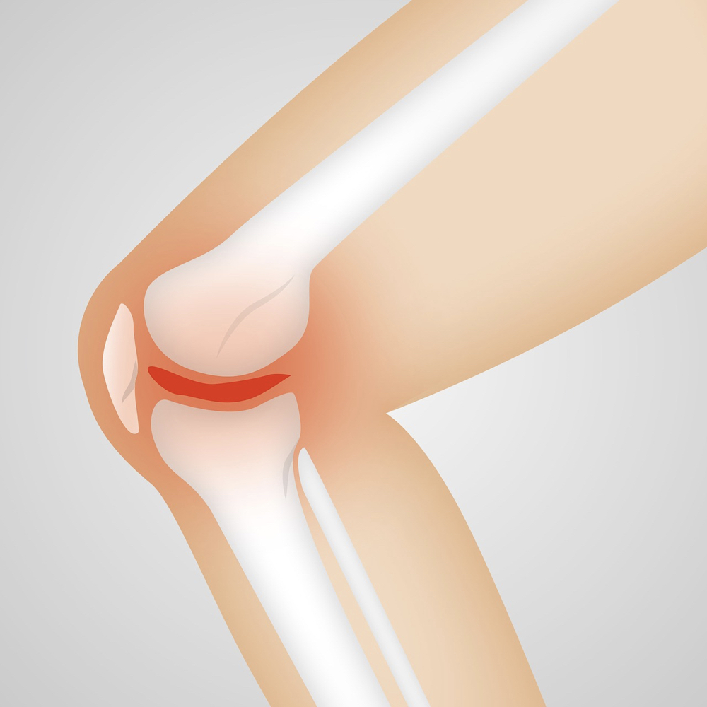 Osteoartritis