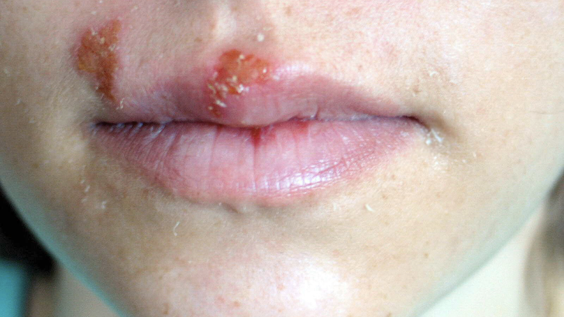 Herpes labial o papiloma humano Infecţia cu virusul HPV (Human papilloma virus)