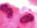 Oxidized Cholesterol 27HC May Explain 3 Breast Cancer Mysteries