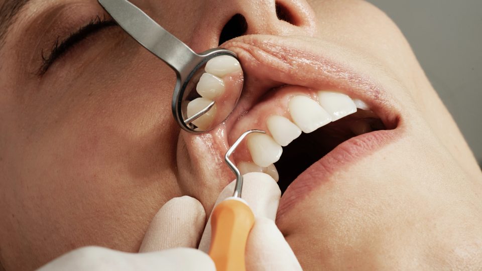 Does Oil Pulling Help Dental Plaque or Gingivitis?<br>