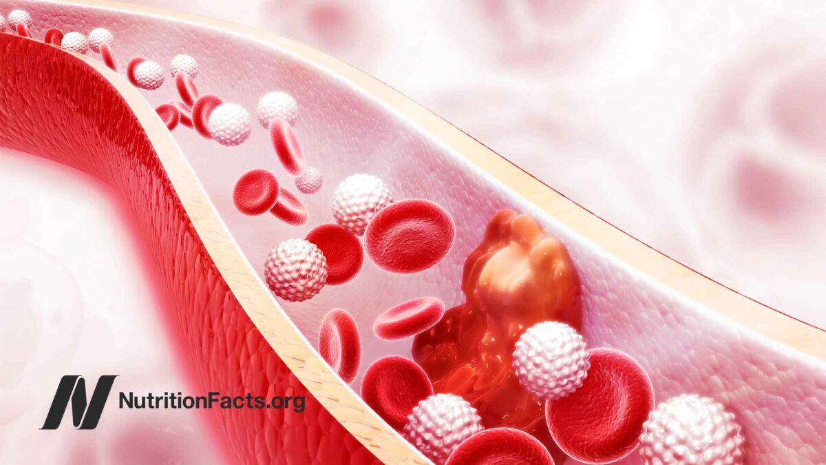 Cholesterol plaque in artery