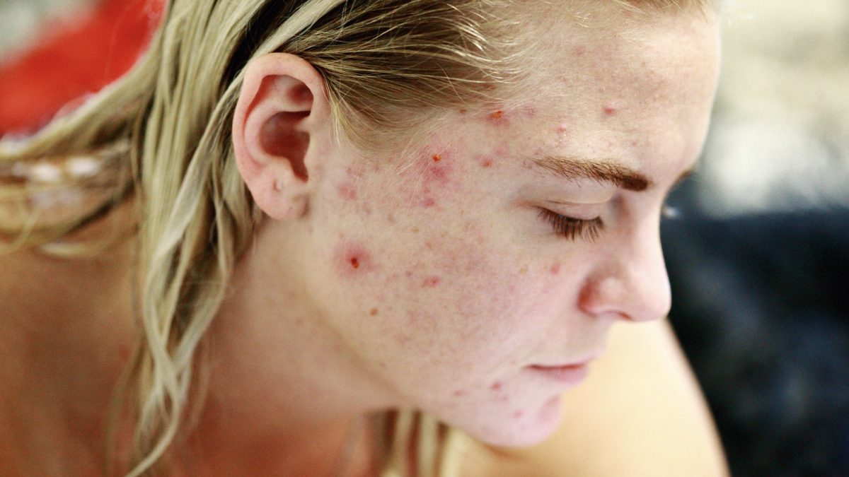 Lady with acne