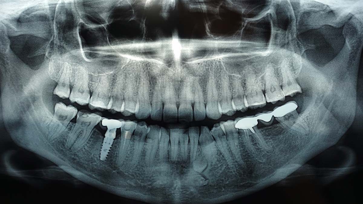 Are Dental X Rays Safe The Brain Tumor Connection