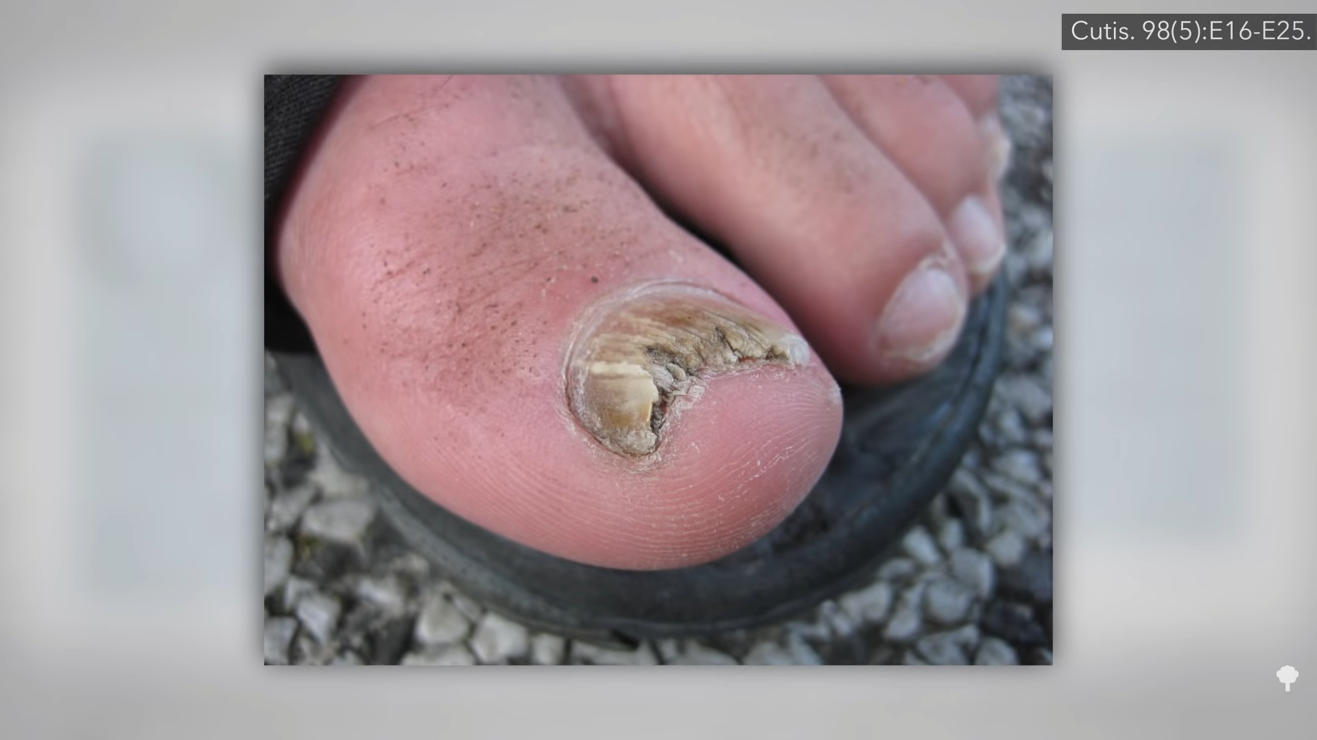 Treating the Root Cause of Toenail Fungus