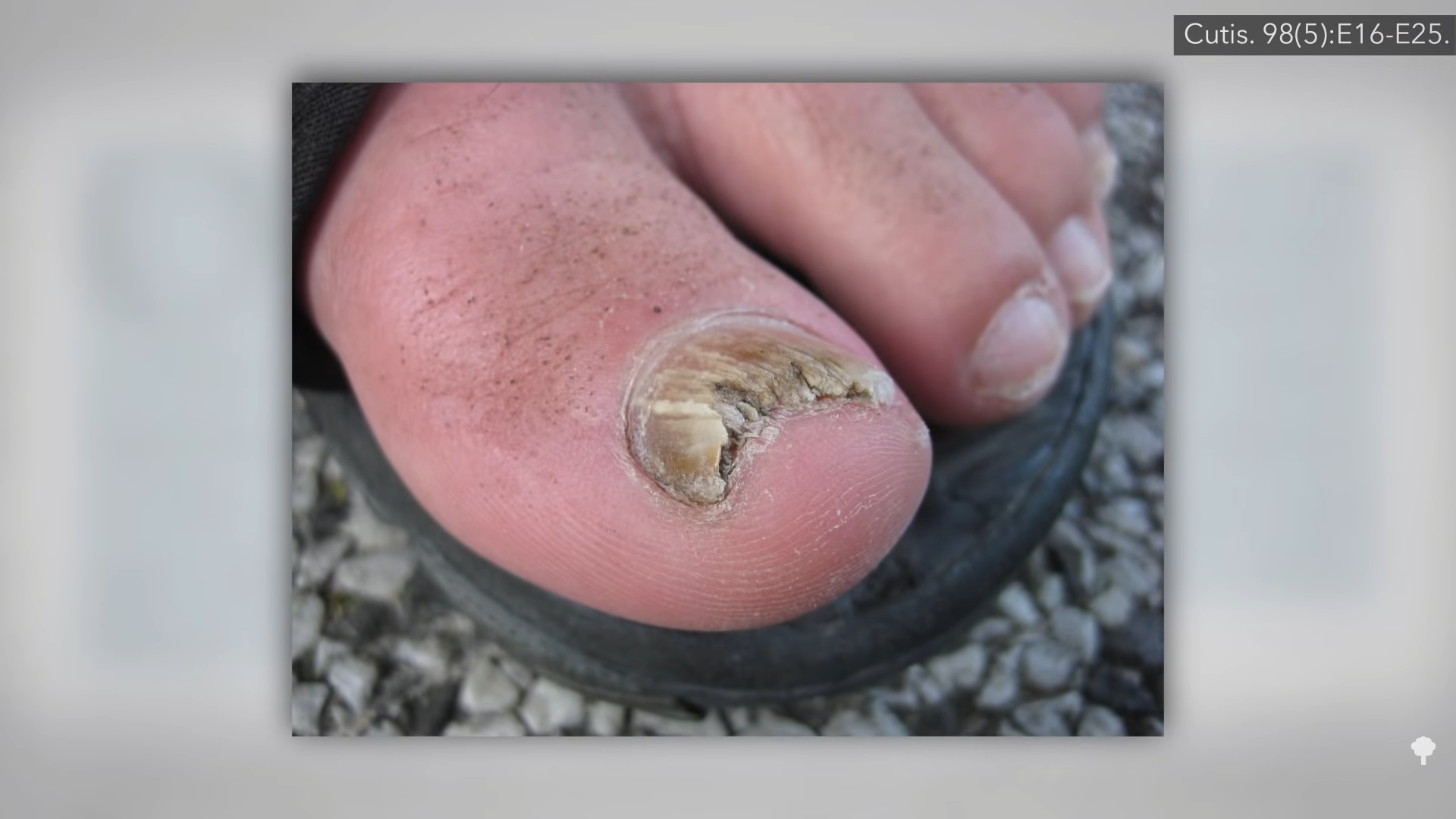 Black Toenails | Podiatry Associates, INC.