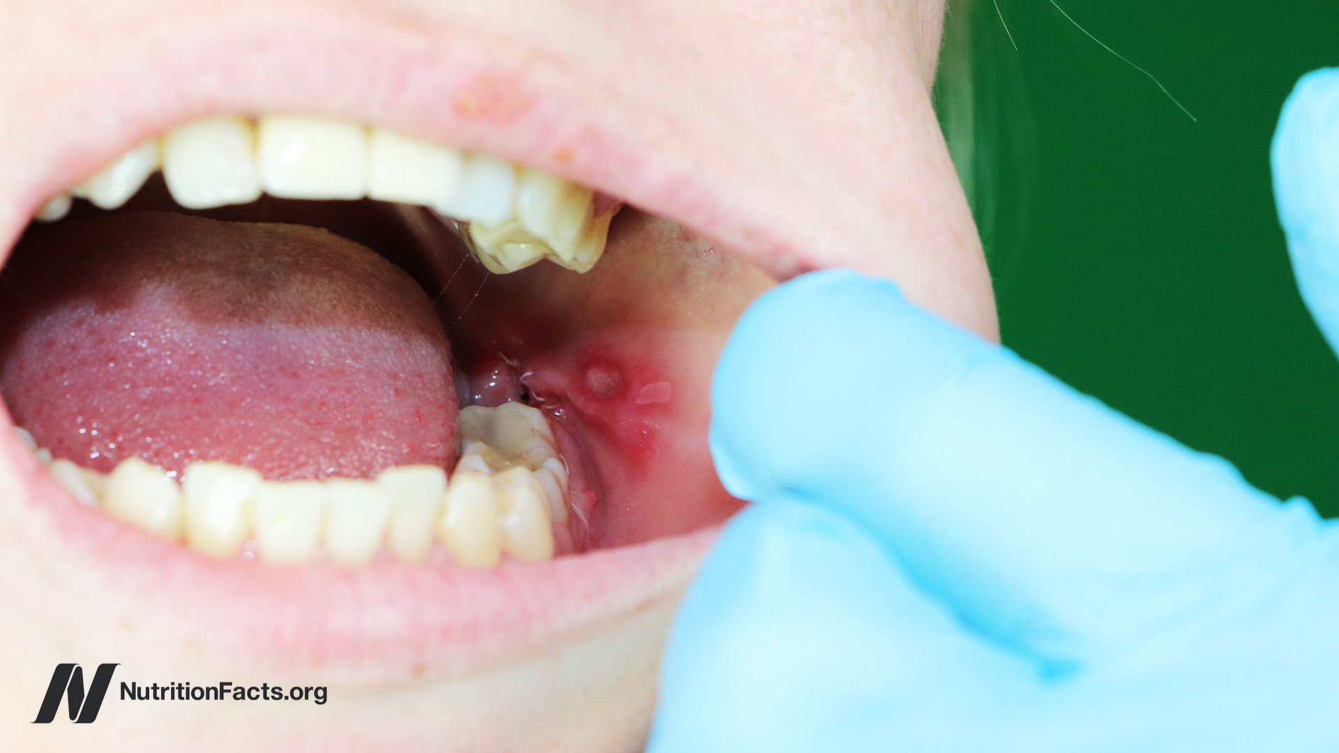 canker sore on upper gum