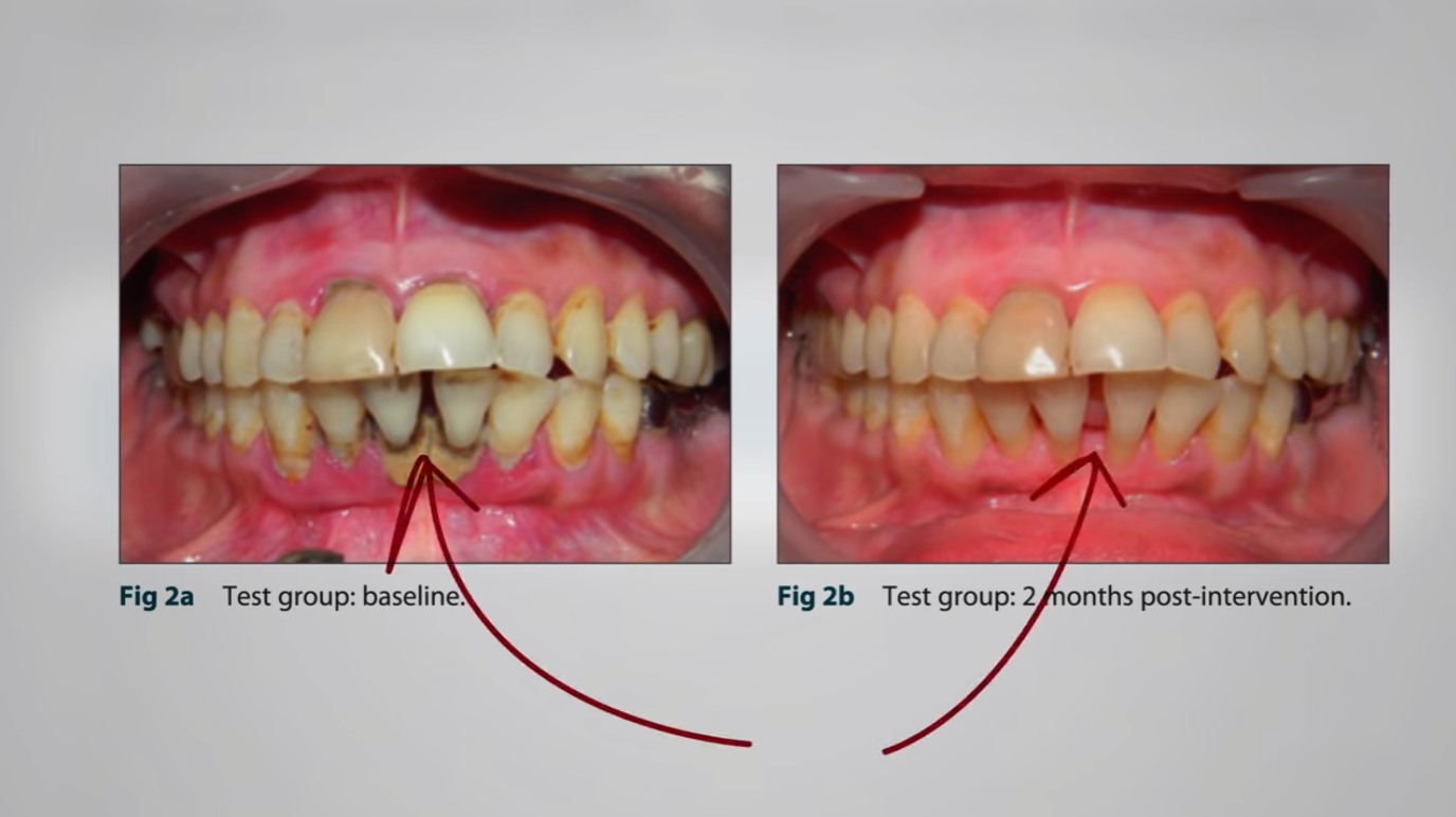 , What Is the Best Food for Gingivitis and Periodontal Disease?