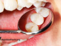 Dental mirror inspecting molars