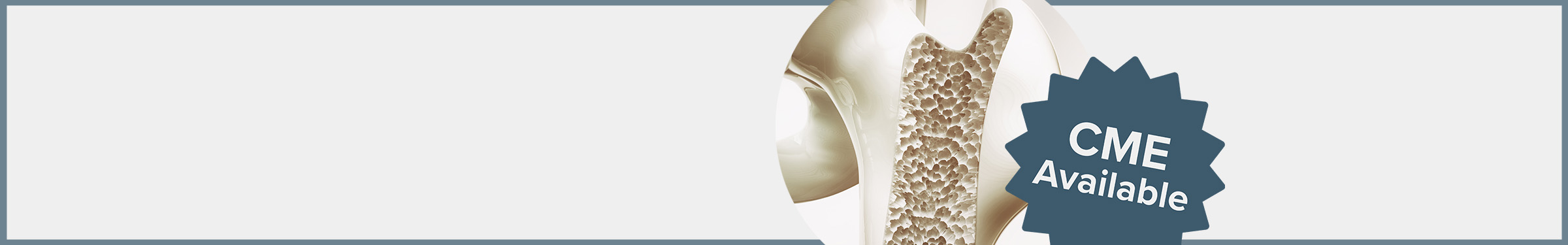 Preventing and Treating Osteoporosis