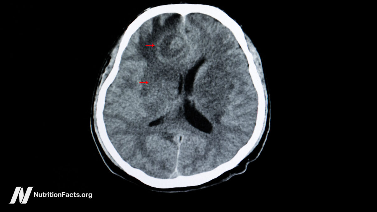 Toxoplasmosis and Schizophrenia 