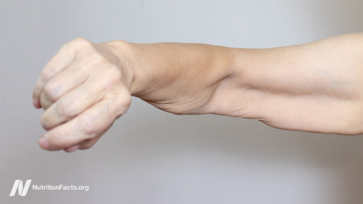 loose muscle on an arm of a senior elderly woman