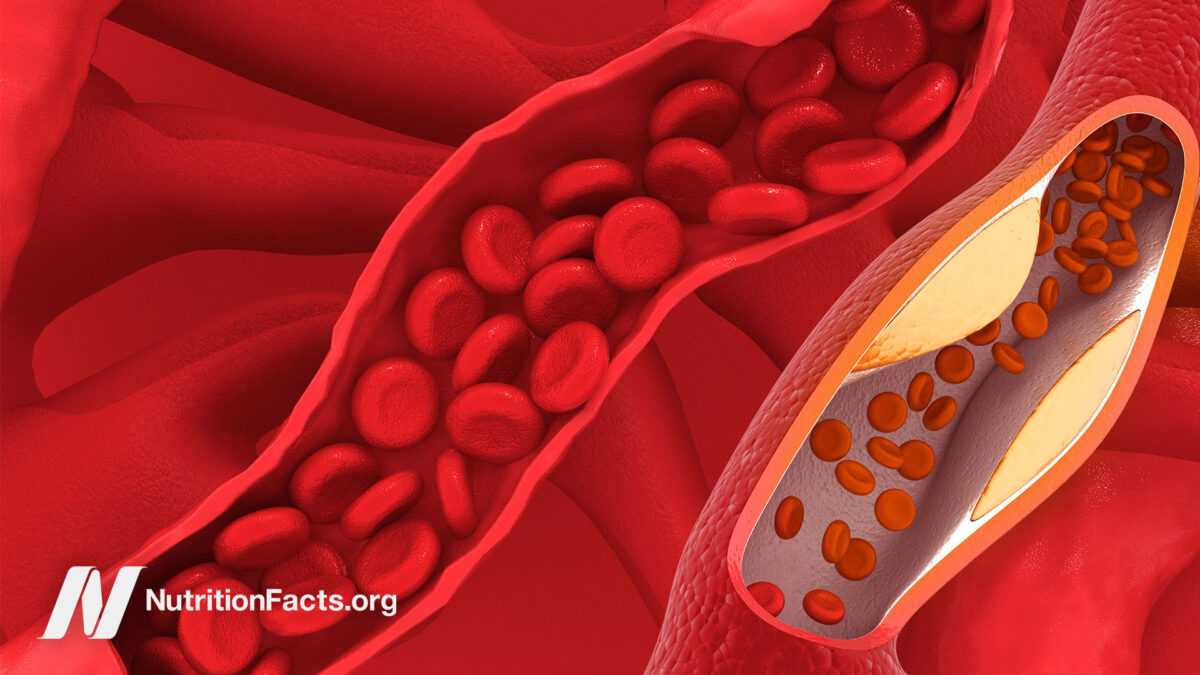 Plaque in arteries