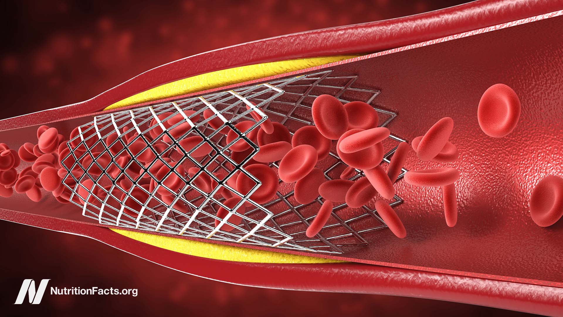 graphic of a cross-section of an artery with a stent in it