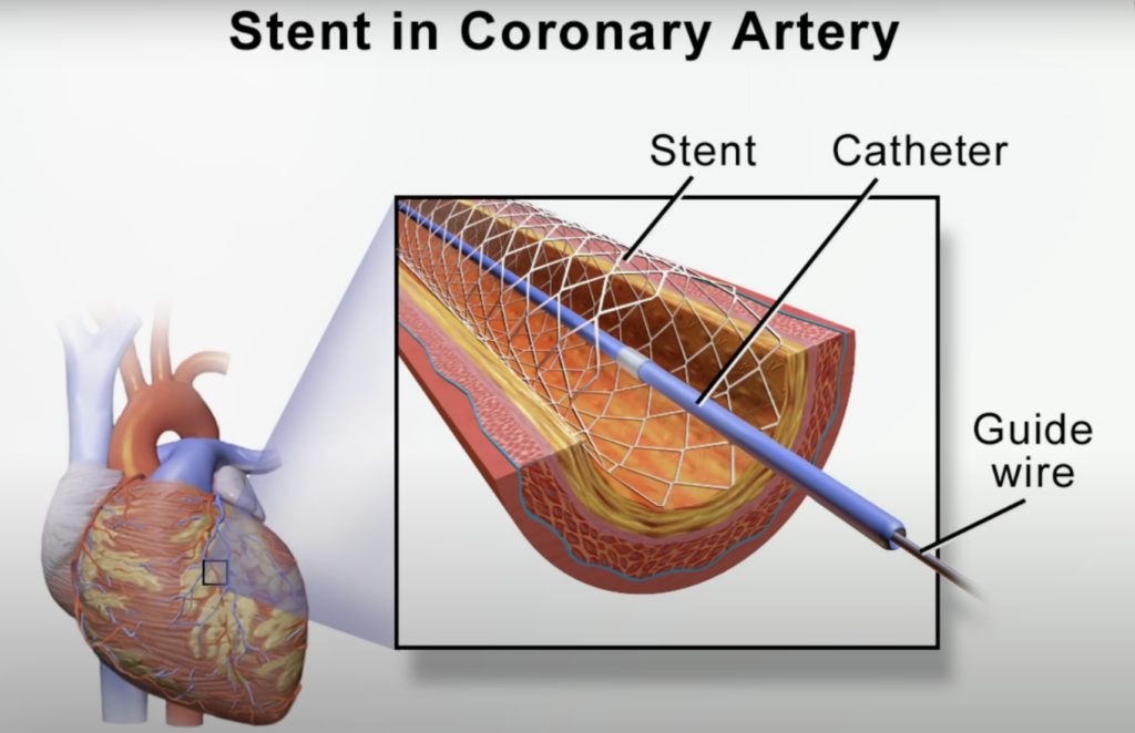 gráfico de um stent em uma artéria coronária