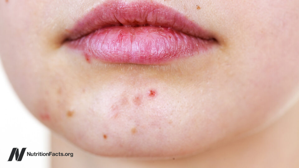 Acne and Vitamin B12 