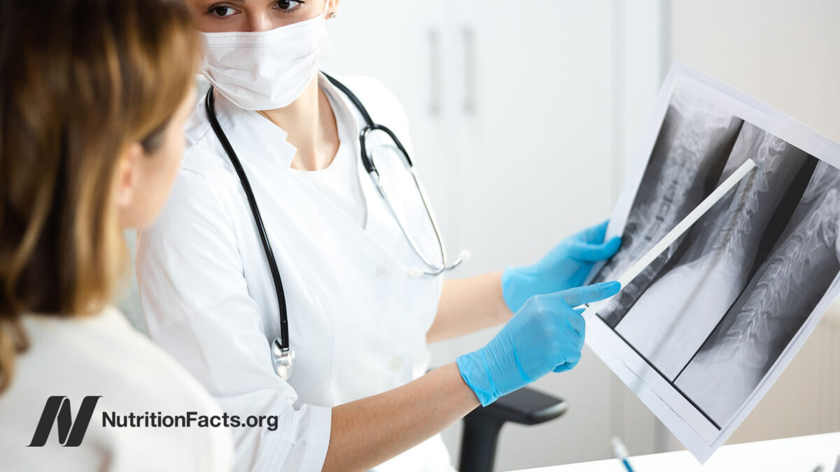 Doctor pointing and examining an x-ray of a patient with Sarcoidosis while speaking with patient